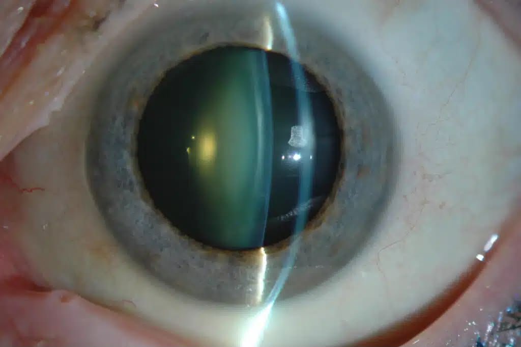 Cirurgia de catarata